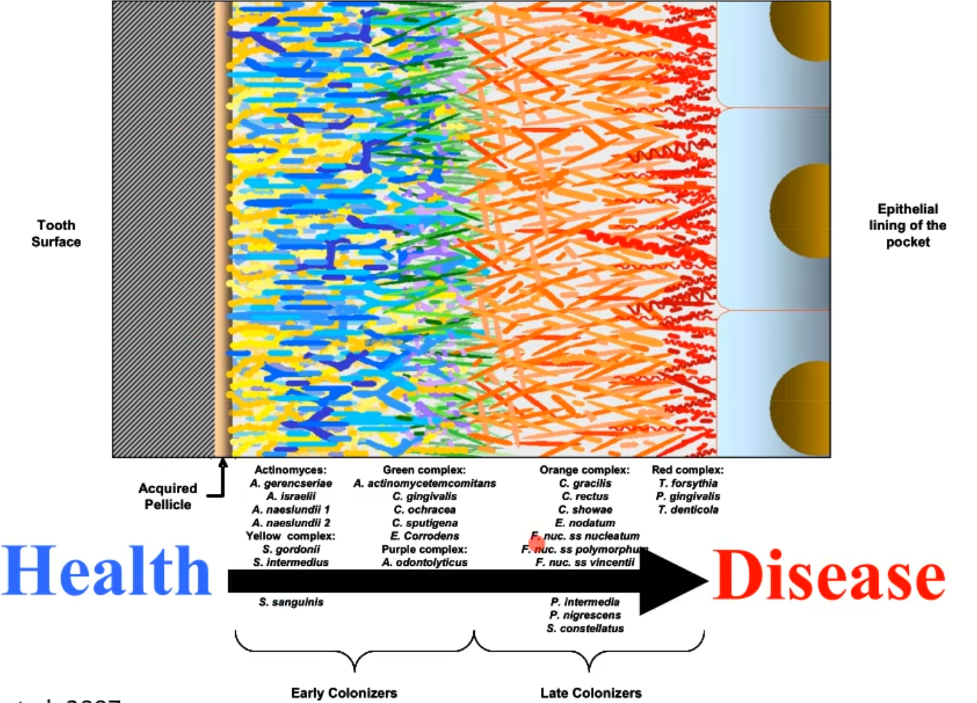 <ul><li><p>pathogenic multi-species plaque biofilm that is a dysiotic system that results in out-growth of the pathobionts </p></li><li><p>the pathobionts are always there, albeit at low levels in health</p><ul><li><p>the thinner the plaque the less likely have a high number of pathobionts</p></li></ul></li><li><p>Reach about 20% of the disease biofilm-highly pathogenic (little virulence bombs)</p></li></ul><p></p>