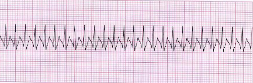 SVT Sustained (>30 seconds) & needs intervention