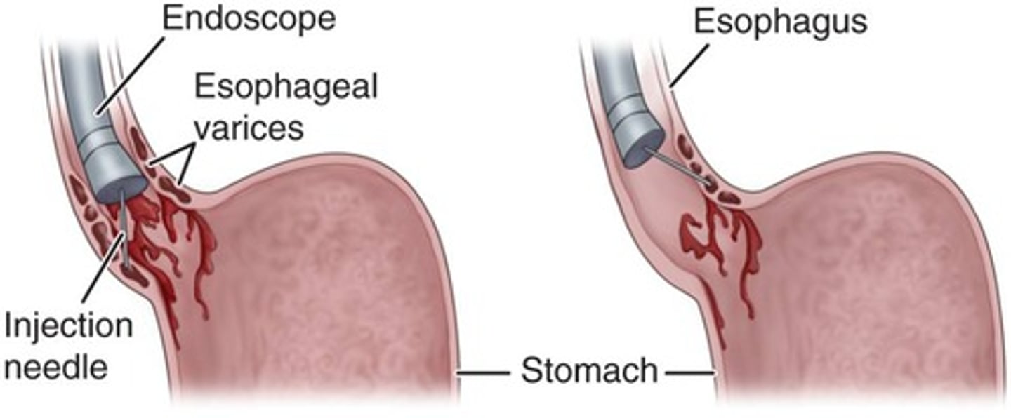 <p>- sclerosing agent injected</p><p>&gt; agent that shrinks the blood vessels to stop bleeding</p><p>- may cause mucosal ulcerations which would increase bleeding</p>
