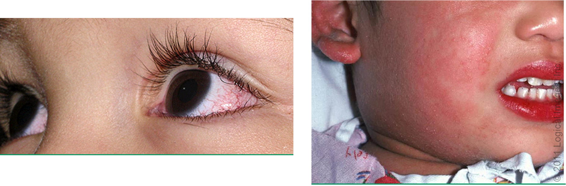 <p>self limiting vasculitis of childhood</p>