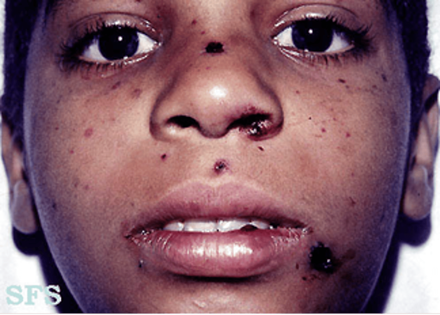 <p>Spontaneous purpuric or hemorrhagic lesions on the skin.</p><p>Patients bruise easily</p><p>May have blood in urine</p><p>Frequent nosebleeds</p><p>Spontaneous gingival bleeding</p><p>Petechiae</p><p>Clusters of petechiae or purpuric spots</p><p>Ecchymosis</p>