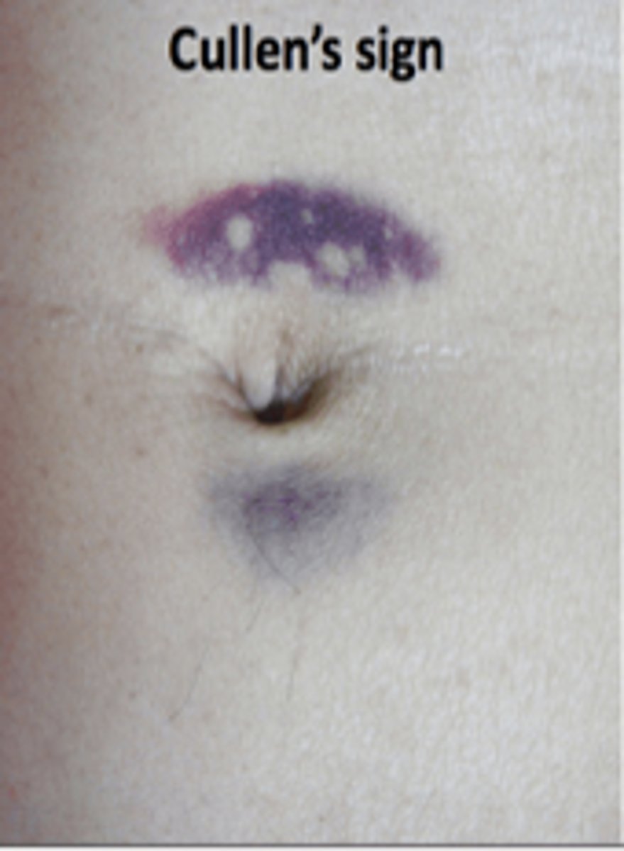 <p>Bluish peri umbilical discoloration from blood in the peritoneal cavity</p><p>PANCREATITIS SIGN</p>