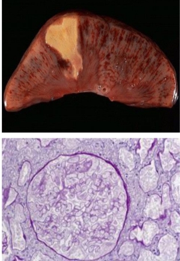 <p>What type of necrosis is this and where is it commonly seen?</p>