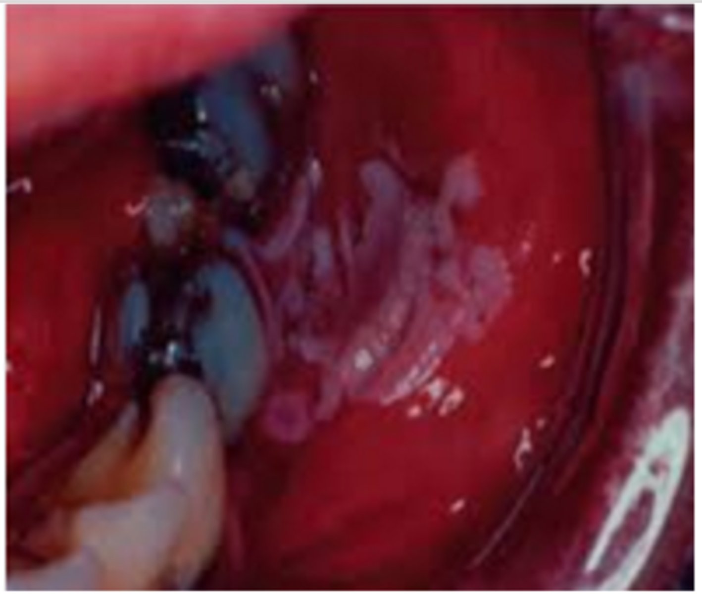 <p>They wrote a short case study, explaining patient suffering of severe pain, swollen gingiva with toothache and they put picture of white patches against the tooth area, they ask what is the cause:</p>
