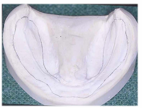 <p><strong>draw an outline on the primary cast</strong>, this pencil outlines represents the denture bearing area - which is the soft tissue that will support the denture</p>