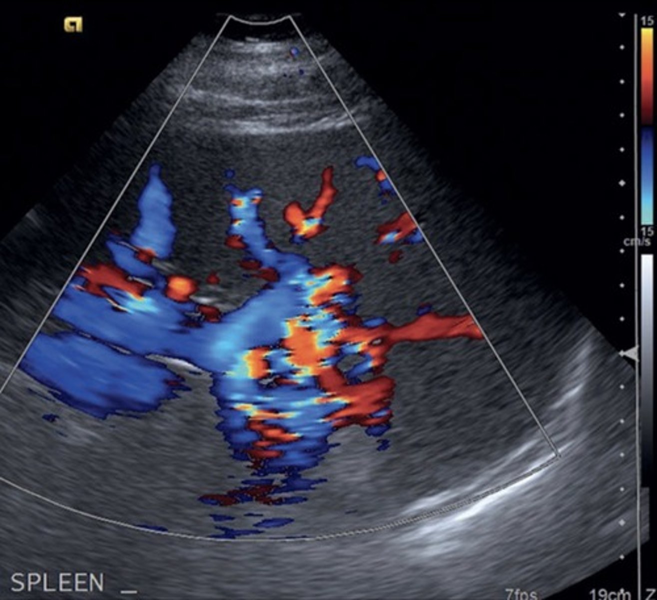 <p>Prominent veins at splenic hilum</p><p>Hepatofugal flow in splenic vein</p>
