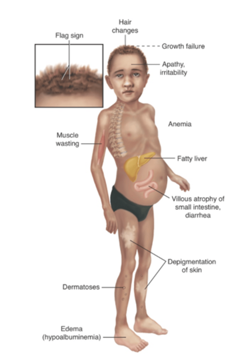 <p>Characterized as a protein deficit that is relatively greater than the reduction in total calories</p><p>In Westernized countries, see with alcohol use disorder.</p>