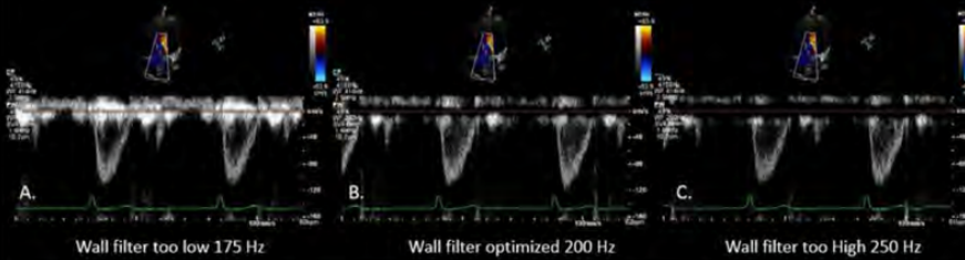 <p><strong>eliminate low V signals near baseline</strong></p><p>remove unwanted noise w/out erasing flow info</p>