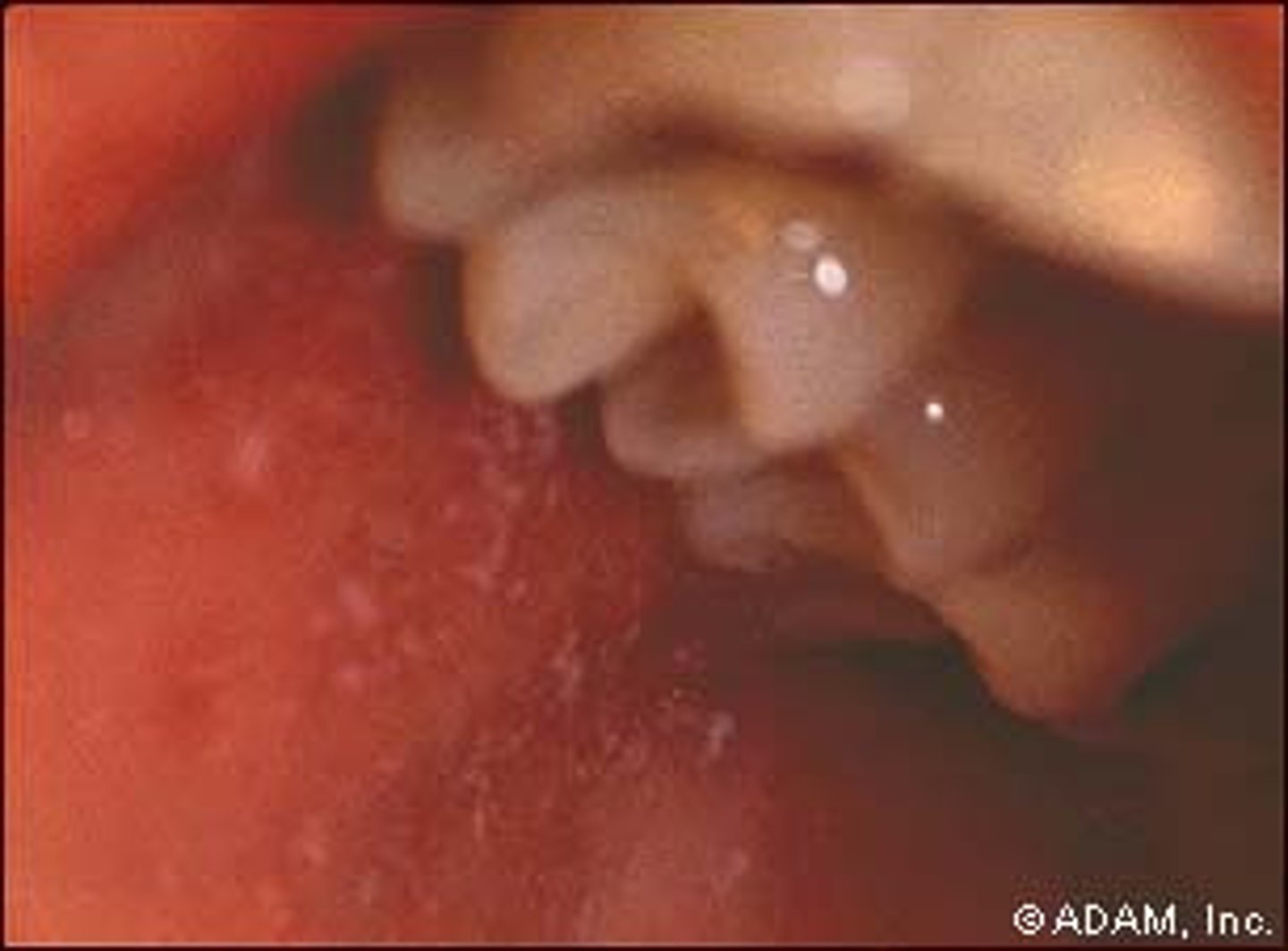 <p>associated with koplik spots, white spots on buccal mucosa</p><p>-pathognomonic for measles</p>