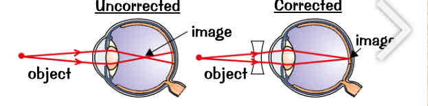 <ul><li><p>short-sighted people are unable to focus on distant objects:</p><ol><li><p>occurs when lens is wrong shape &amp; refracts light too much or the eyeball is too long</p></li><li><p>images of distant objects are brought into focus in front of the retina</p></li><li><p>you can use glasses with concave lens (lens which curves inwards) to correct it, so that light rays focus on the retina</p></li><li><p>medical term for short-sightedness → myopia</p></li></ol></li></ul>