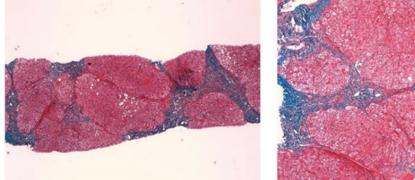 <p>Imagen de hígado (no aparece completa).. en los laboratorios muestra aumento de las transaminasas hepáticas (ALT, AST), por lo que se decide hacer una biopsia, observándose nódulos parenquimatosos irregulares, rodeados por bandas de fibrosis y con hepatocitos balonizados de citoplasma vacuolado, rodeado por infiltrado linfocitario, como se ve en la micrografía: </p>