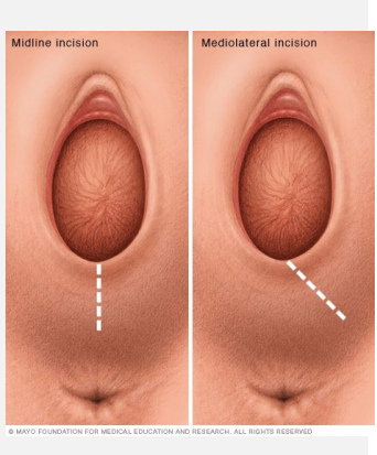 <p><strong>Episiotomy</strong>&nbsp;</p><p>-Incision made in __________ → either mediolateral or ________</p><p>-Indications → need to hasten delivery or impending/ongoing shoulder ________</p>