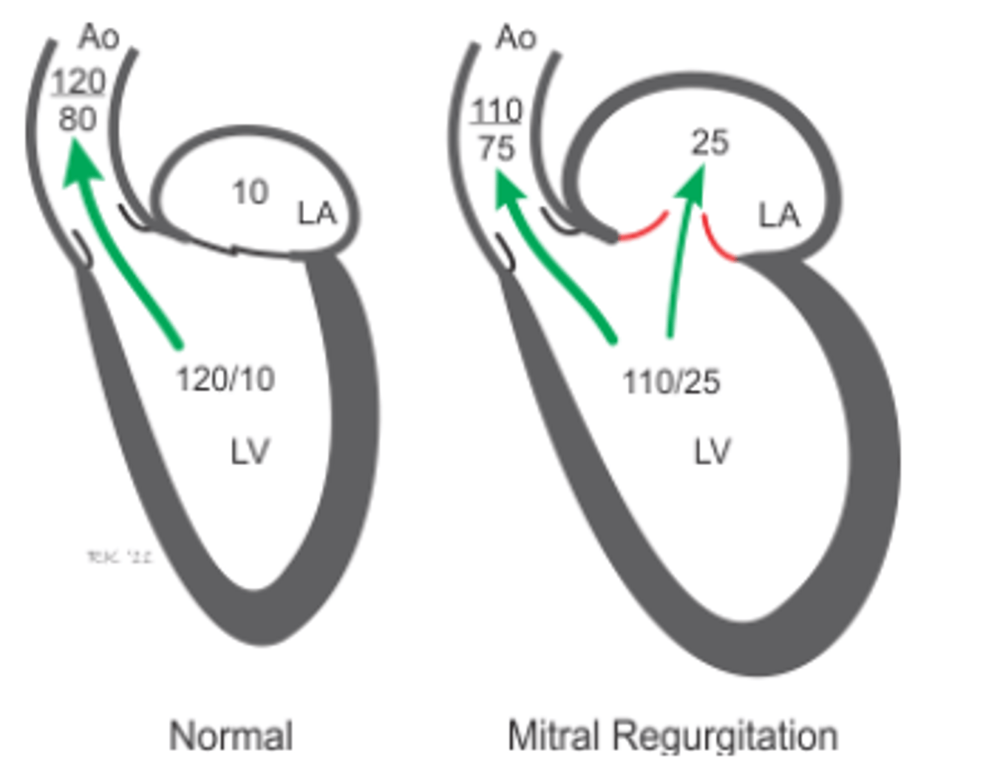<p>Aorta: systolic &amp; diastolic is lower</p><p>LV: systolic is lower but diastolic is higher</p><p>LA: higher</p>