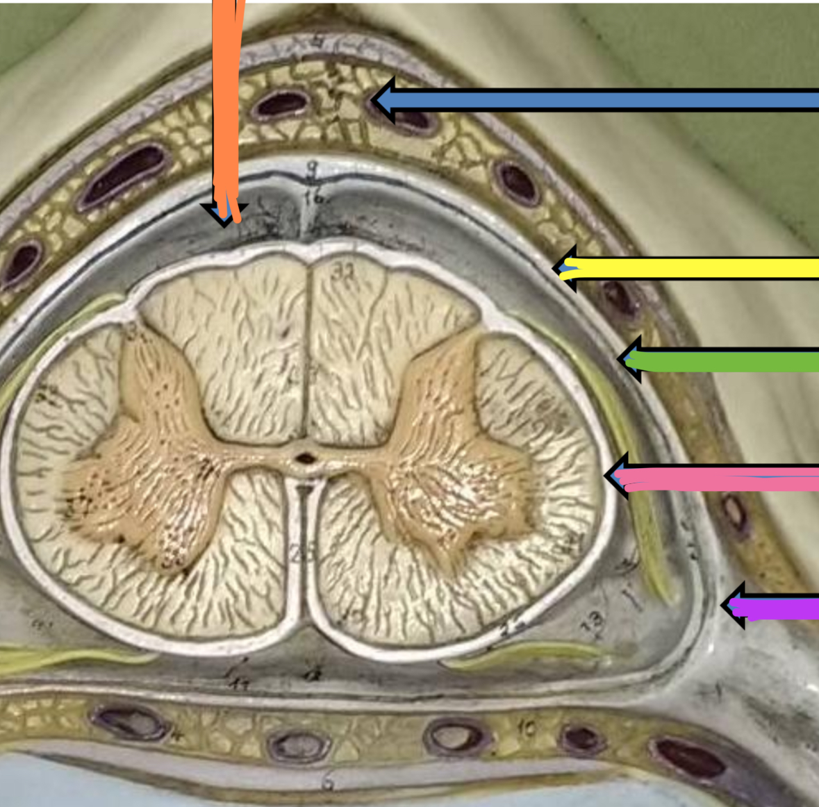 <p>Yellow AND Purple&nbsp;points to what Meninge/meningeal space&nbsp;</p>