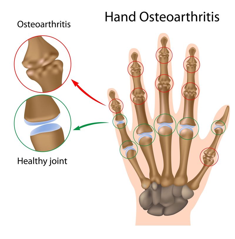 <p>Wear-and-tear arthritis causing joint degeneration. Starts at the hands (ends of the fingers). </p>