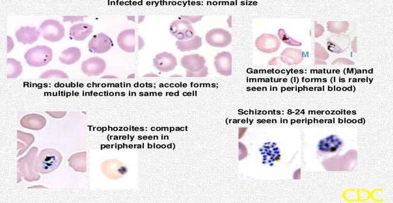 <p>normacytic rbc, multiple rings in rbc (<span style="color: red">headphone shape</span>)</p><p><span style="color: red">accole</span>/applique form (rings plaster onto rbc membrane)</p><p>gametocyte: <span style="color: red">banana shape</span></p><p>schizonts: rarely seen in PBP</p>
