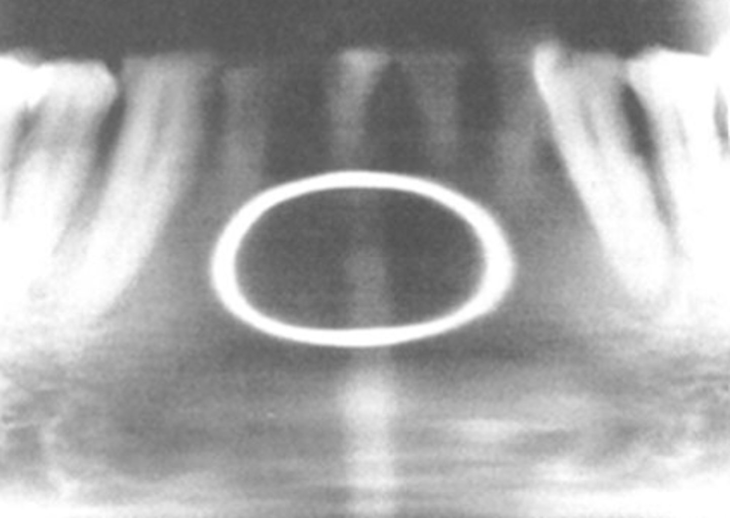 <p>In this image, the teeth are ___ the groove of the bitestick</p><p>A) in front of</p><p>B) behind</p>