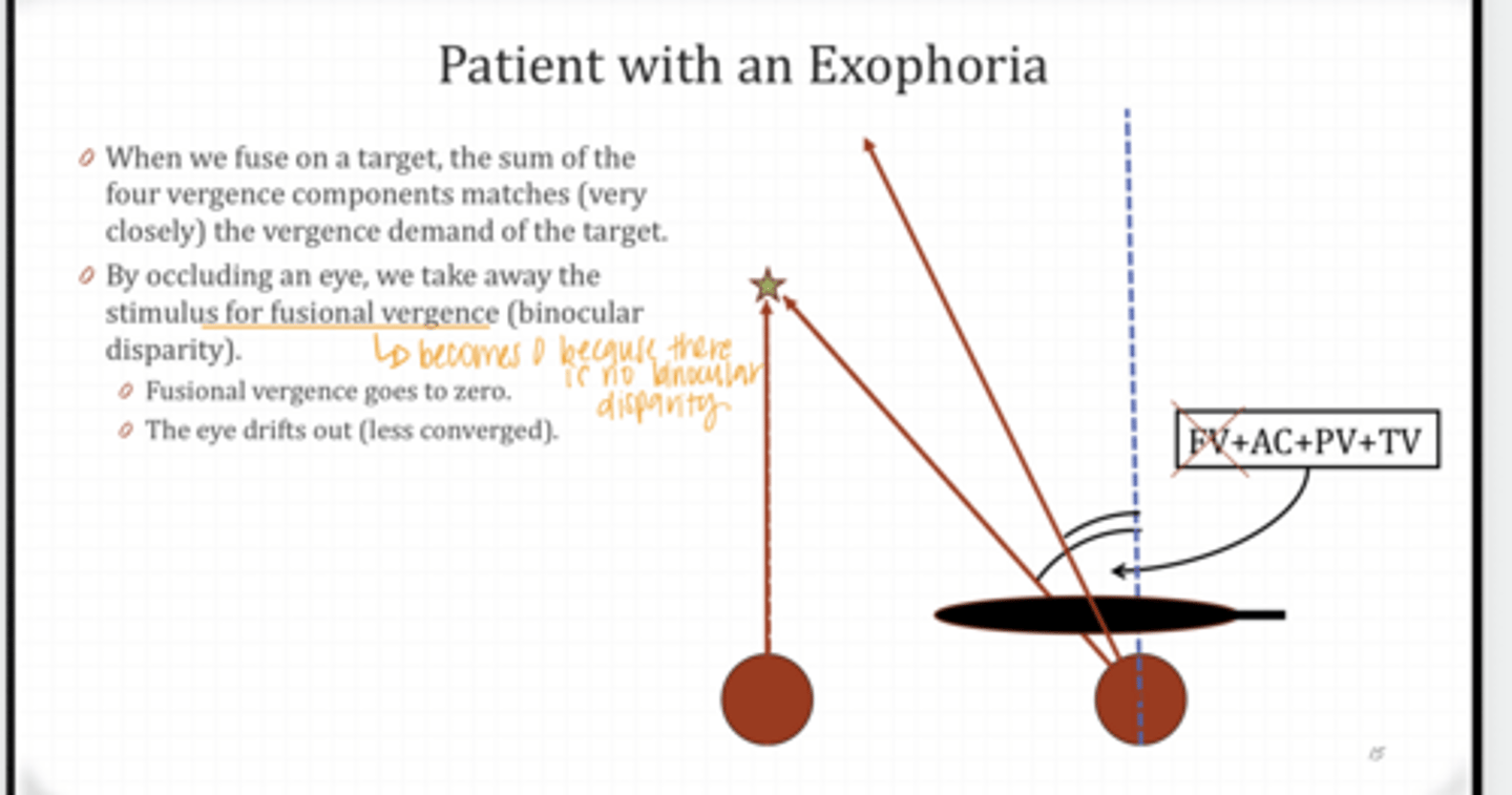 <p>Patient with an EXOphoria Example</p><p>The eye will drift where? (more/less) converged?</p>