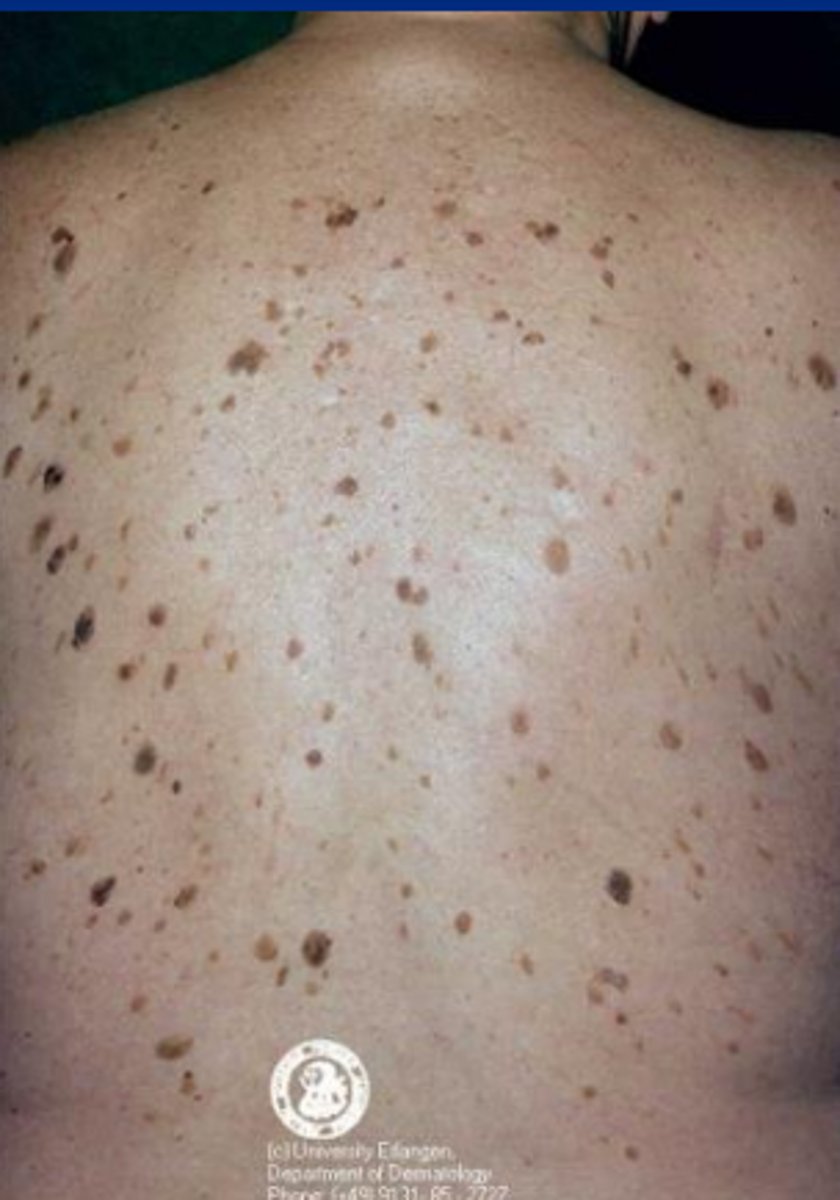 <p>= tumor die ontstaat uit keratinocyten en adnexen, ook wel bijgenaamd een verruca senilis</p><p>= geelbruin/grijsbruin aspect, stuck-on appearance</p>