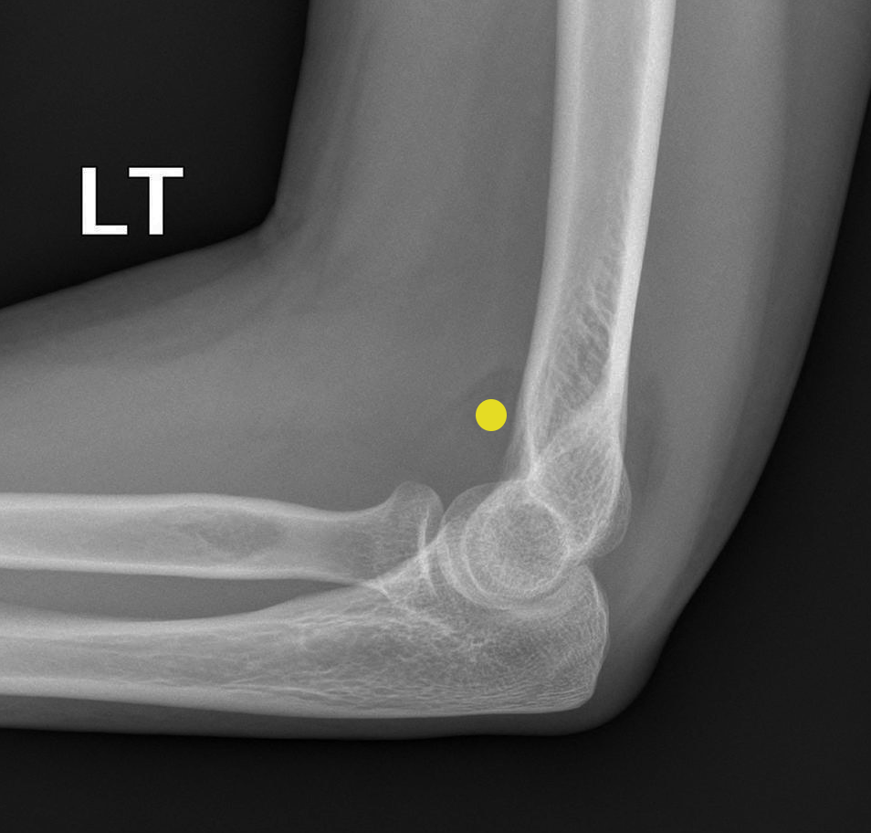 <p><span>A 30 year old woman fell off a push-bike onto the left arm. A lateral radiograph shows elbow joint effusion, indicated by the 'sail sign' (yellow dot) of the anterior fatpad.</span></p>