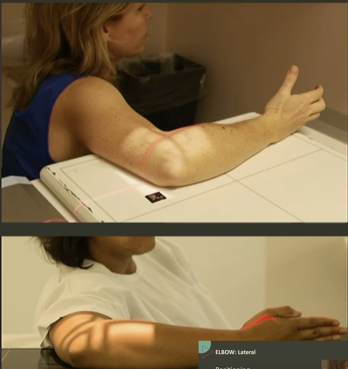 <p>Fine FS, 100cm</p><p>60kVp/3mAs</p><p>Straight tube</p><p>CR: Elbow joint</p>