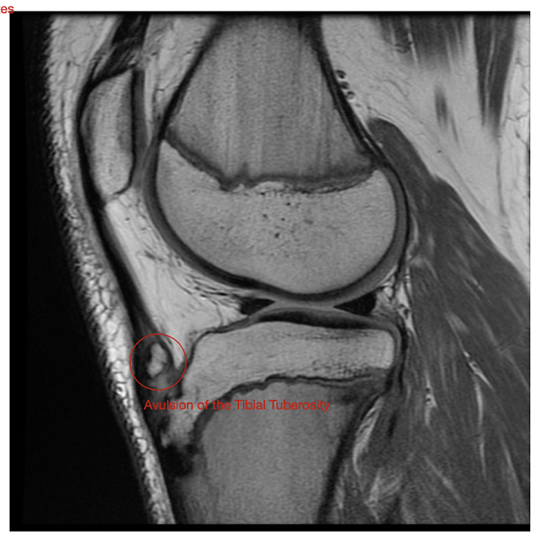 <p>Osgood Shlatter’s: </p><ul><li><p>Main Pop:</p></li><li><p>4 MOI</p></li></ul><p></p><p></p>