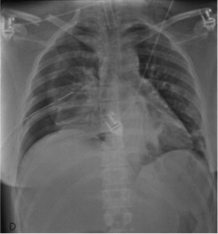 <p>Mobile CXR review for pathology</p>