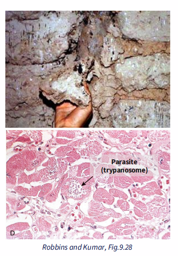 <p>- Parasitic infection - Trypanosoma cruzi</p><p>- Transmitted by insects (triatomine), live in cracks of poorly constructed homes</p><p>- 10 million people are infected worldwide</p><p>- some control achieved through vector control, screening</p><p>- further control could be achieved by improving living conditions</p><p>- Causes destruction of heart muscle: inflammatory response; necrosis</p><p>- Acute attack: 10% die</p><p>- Chronic, immune-mediate: congestive heart failure, arrhythmia</p>