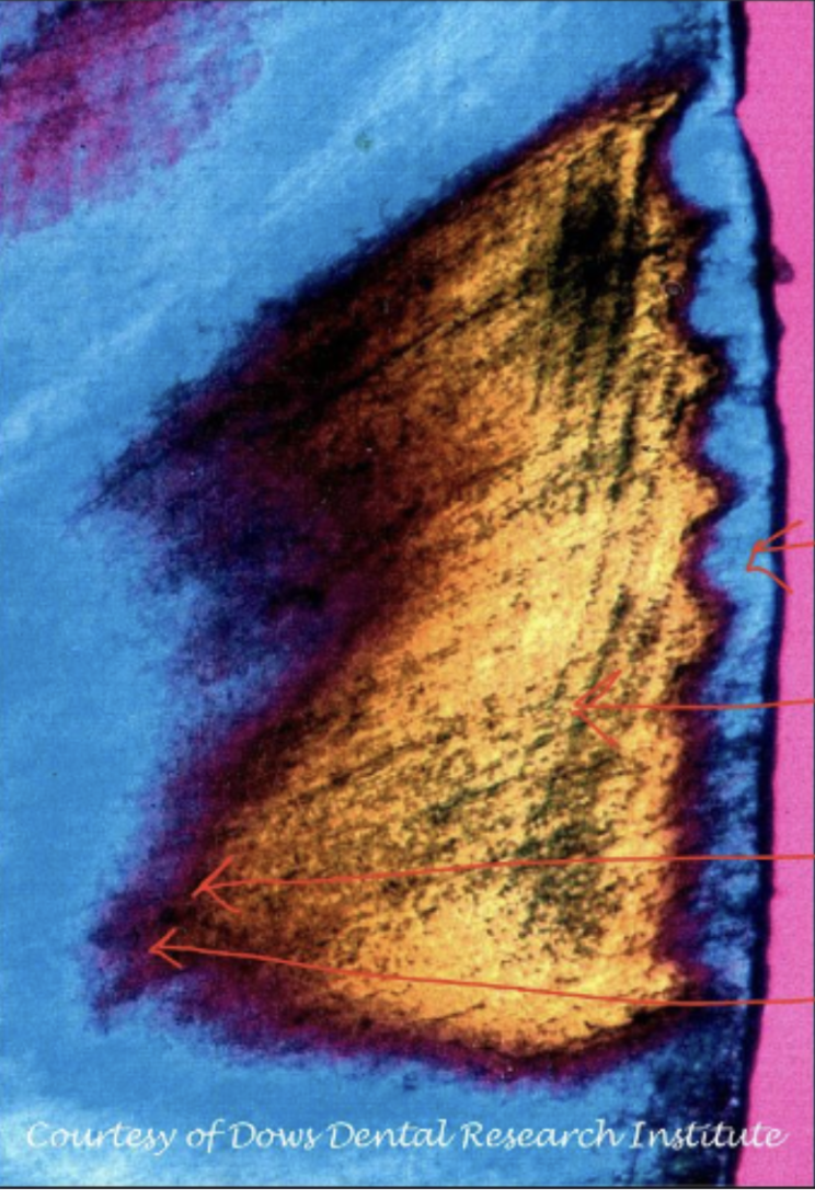 <p><span style="background-color: transparent;"><span>What is the lesion’s name in the picture where the arrow is pointed at?</span></span></p>