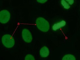 <p>Identify the antinuclear antibody (ANA) staining pattern in the image (a) and interpret what related disorder can be associated with this pattern? </p><p>A. Homogeneous or Diffused staining pattern; Systemic Lupus Erythematosus </p><p>B. Homogeneous or Diffused staining pattern; Scleroderma </p><p>C. Nucleolar staining pattern; Sjogren's syndrome </p><p>D. Peripheral or rim staining pattern; active Systemic Lupus Erythematosus</p>