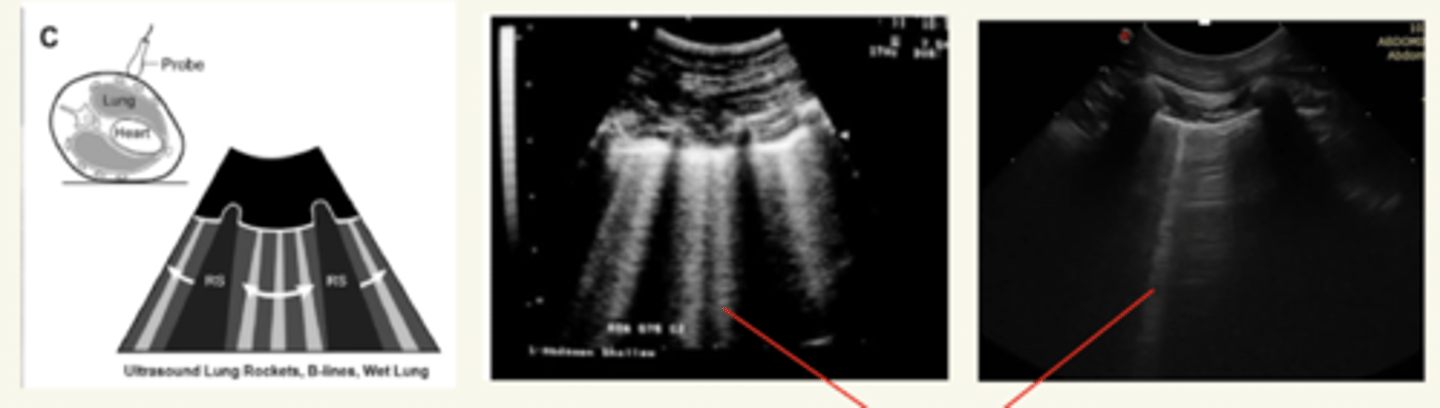 <p>B-lines</p><p>(líneas hiperecoicas verticales)</p>