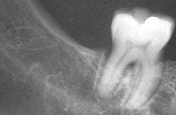 diffuse PDL widening