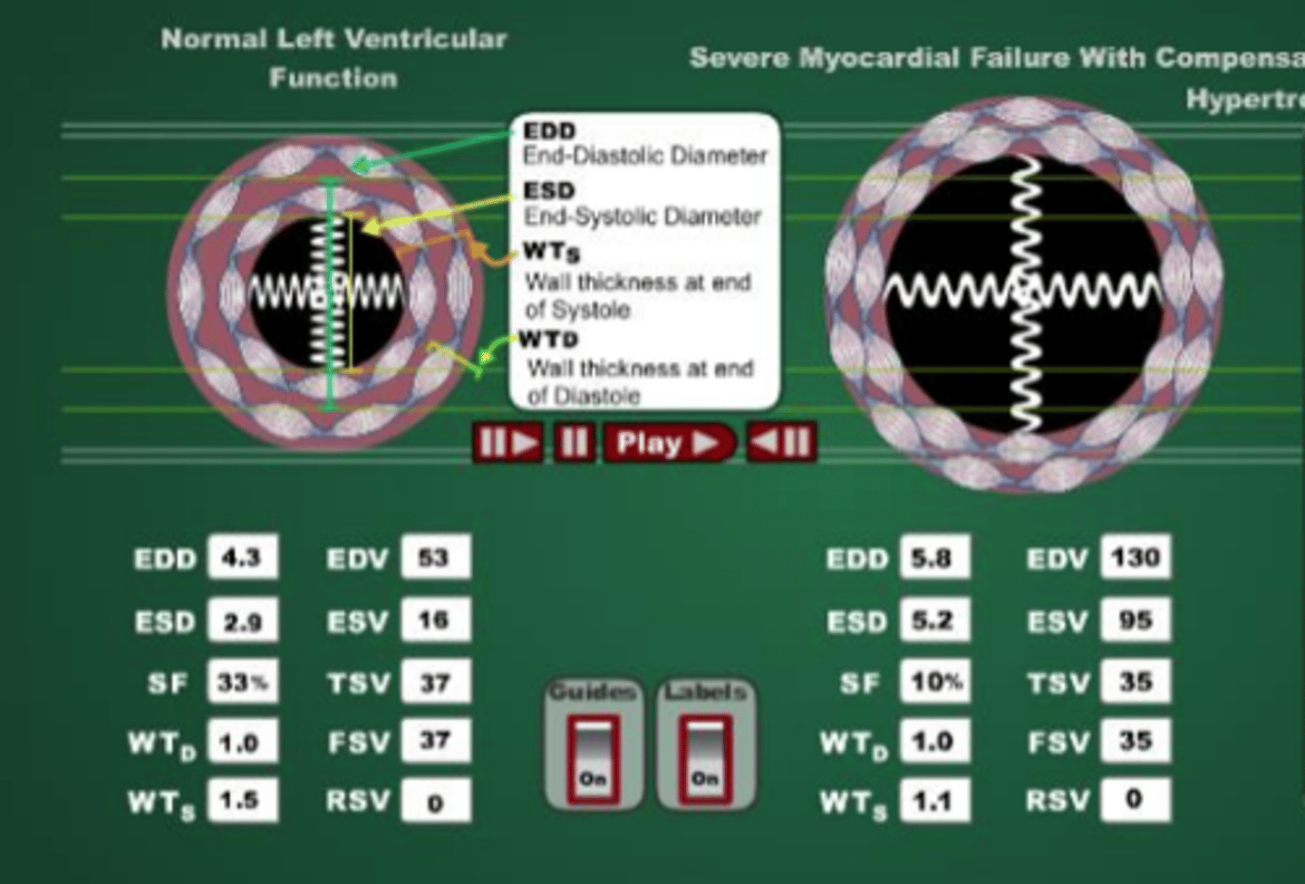 <p>The heart has a harder time contracting, so ESV is higher then in a normal heart, but the EDV also increases in order to maintain FSV.</p>