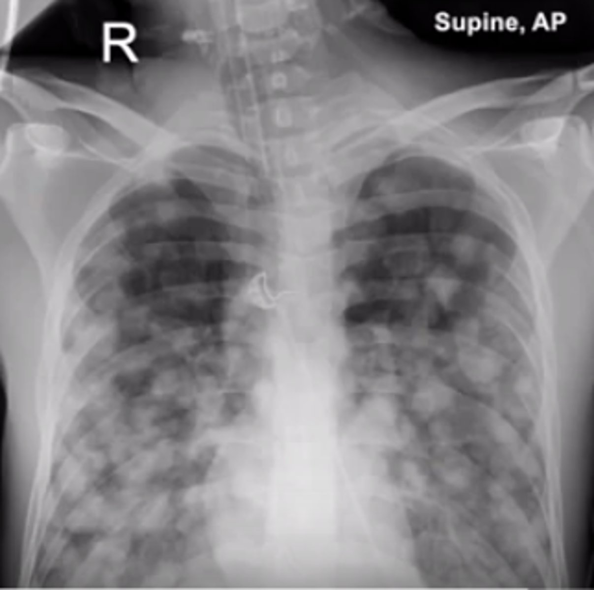 <p>lungs : cannonball metastasis</p>