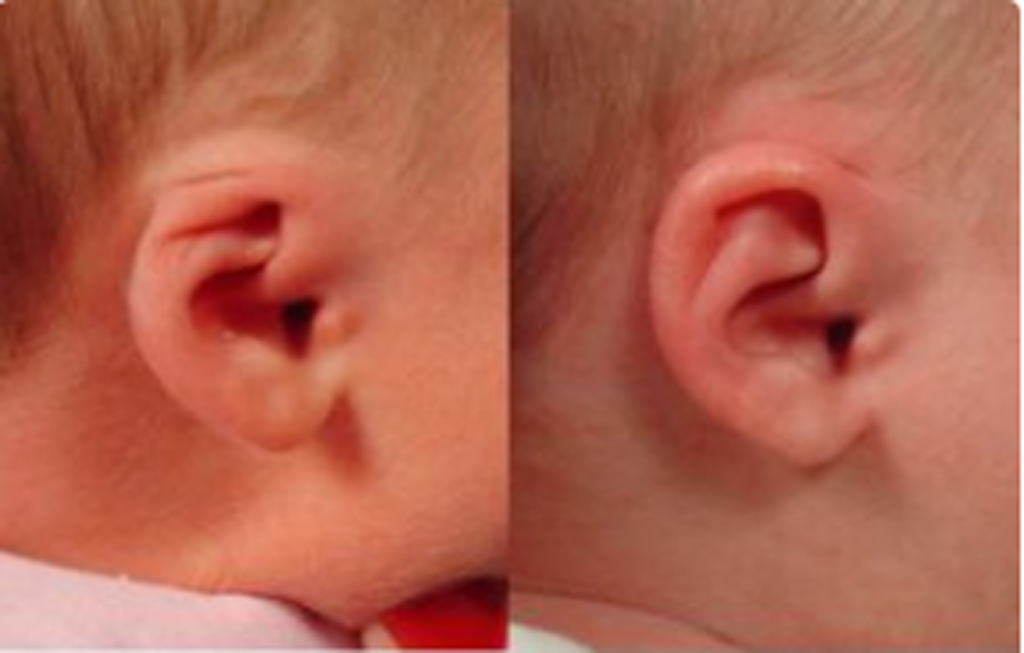 <p>Congenital absences or maldevelopment of upper portion of the ear</p>