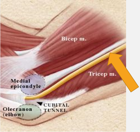 <p>The Arcade of Struthers for ulnar nerve entrapment consists of a fibrous tunnel that is 8cm above the</p>