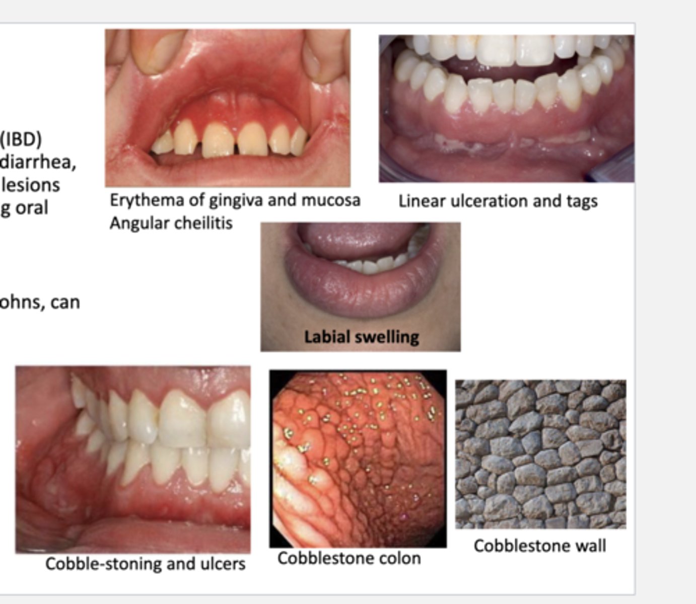 <p>-cobble-stone appearance (specific to crohn's)</p><p>-linear ulceration</p><p>-mucosal tags</p><p>-mucositis &amp; gingivitis</p><p>-labial &amp; facial swelling</p><p>-angular cheilits</p><p>-aphthous ulcers</p>
