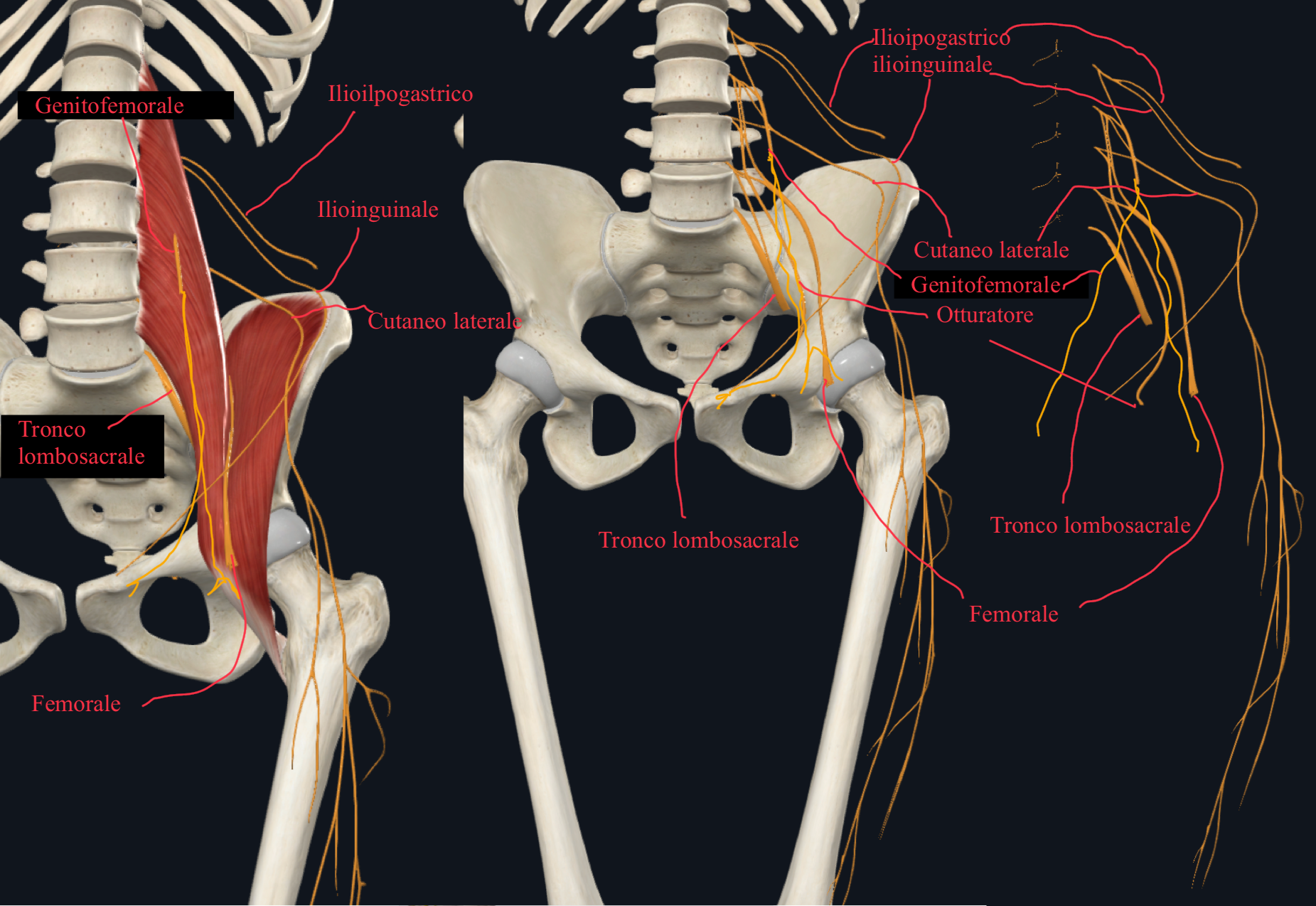 <p>Rami che emergono dal margine laterale del grande psoas:</p><ul><li><p>Nervo Ileoipogastrico e ileoinguinale</p><ul><li><p>Questi decorrono lungo la parete posteriore e laterale dell’addome decorrendo tra muscolo trasverso e obliquo interno innervandoli</p></li><li><p>L’ileoinguinale decorre in corrispondenza dalla spina iliaca anteriore superiore e si impegna nel canale inguinale (attraversa la parete posteriore e esce dall’anello superficiale)</p></li><li><p>Raggiungono e innervano la regione ipogastrica e inguinale, qui rami cutanei sensitivi innervano la cute soprastante</p></li></ul></li><li><p>Nervo Cutaneo Laterale della coscia</p><ul><li><p>Più inferiormente per poi passare sotto il legamento inguinale entrando nella coscia passa</p></li><li><p>Innerva cute parte laterale della coscia fino al ginocchio</p></li></ul></li></ul><p>Ramo che emerge dalla faccia anteriore:</p><ul><li><p>Nervo Genitofemorale</p><ul><li><p>Divide in un ramo genitale che raggiunge il funicolo spermatico innervando muscolo cremastere e cute genitali esterni</p></li><li><p>E un ramo femorale (sensitivo) che decorre con l’arteria femorale e innerva la cute della coscia</p></li></ul></li></ul><p>Rami che emergono dal margine mediale del grande psoas:</p><ul><li><p>Nervo Otturatore e Tronco Lombosacrale</p><ul><li><p>Il nervo otturatore attraversa piccola pelvi e foro otturatorio raggiungendo la parte mediale della coscia innervando i muscoli mediali della coscia</p></li></ul></li></ul><p>Nervo Femorale:</p><ul><li><p>Accompagna il muscolo ileopsoas attraversando lo spazio retroinguinale e la lacuna dei muscoli lateralmente all’arteria femorale che invece attraversa la lacuna dei vasi</p></li><li><p>Va a innervare il compartimento anteriore della coscia e pettineo (insieme all’otturatore) e invia anche rami cutanei per la superficie anteriore e mediale della coscia.</p></li></ul><p></p>