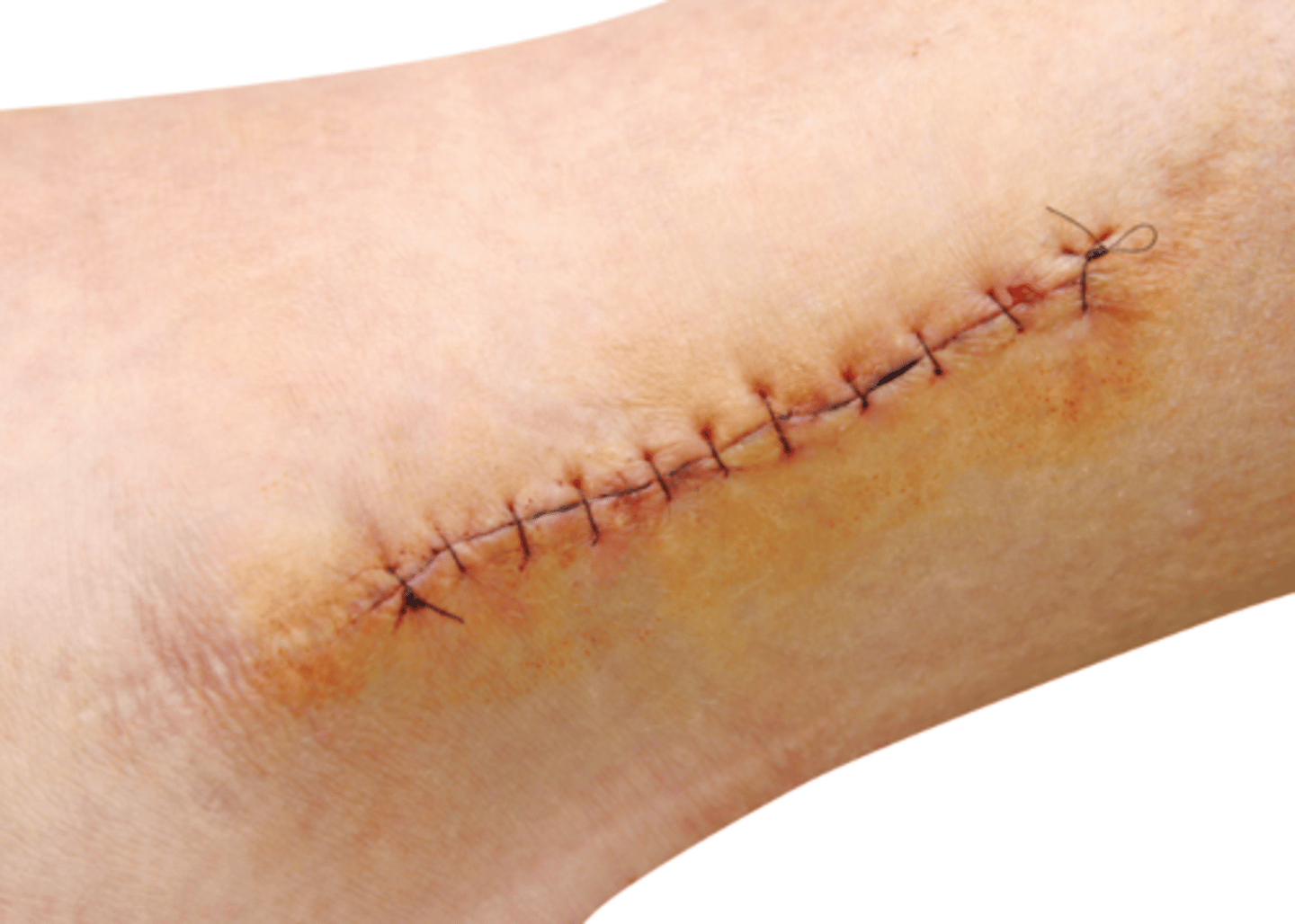 <p>when the edges of a clean wound are closed in some manner immediately (i.e. suture, steri strips, staples)</p>