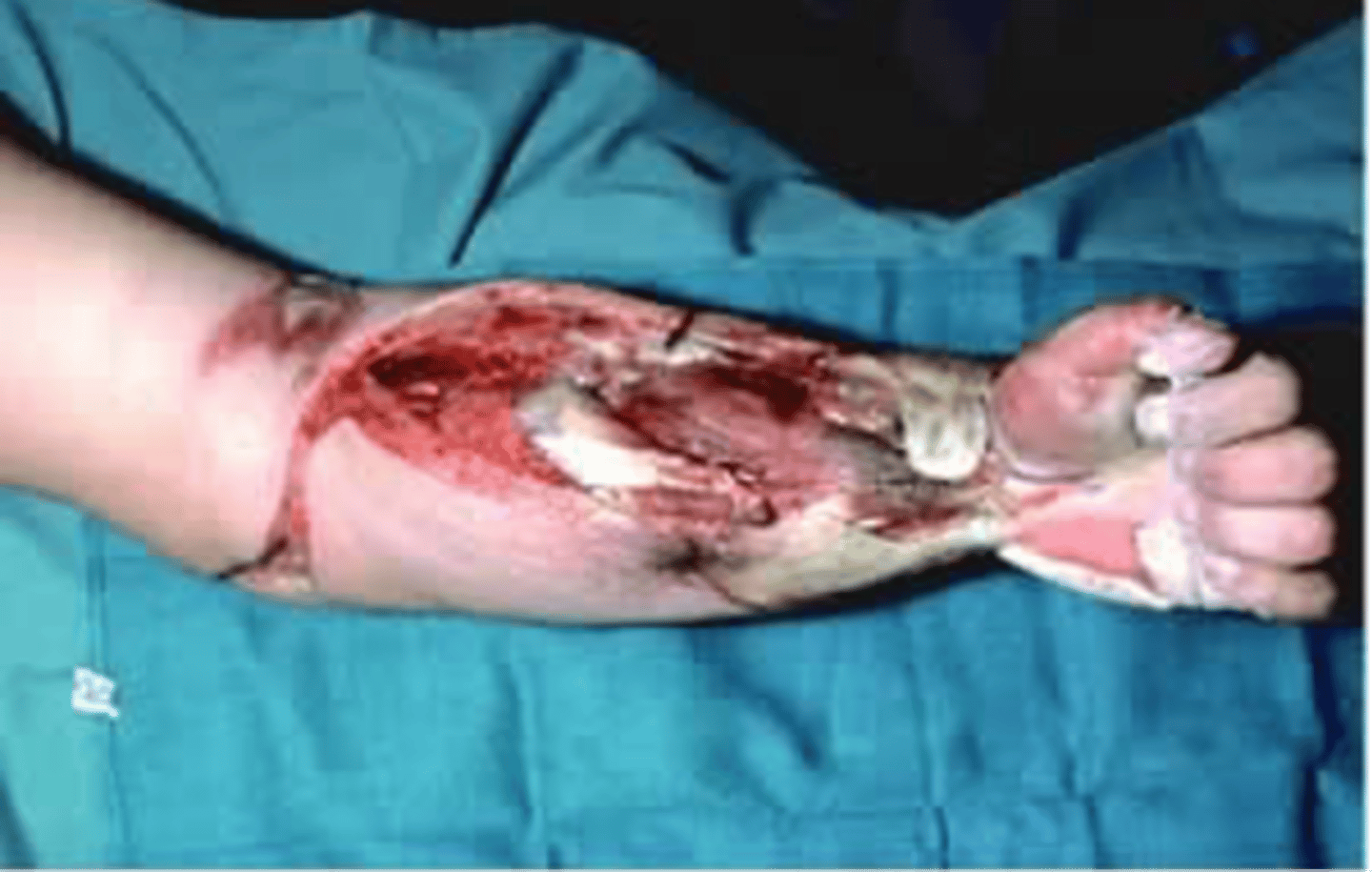 <p>deeper injury (fourth degree)</p>