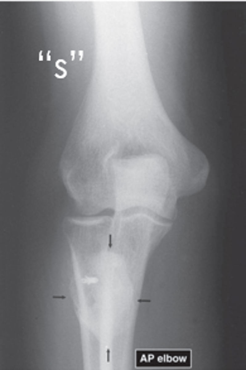 <p>Muscles</p><p>- Look for wasting, swelling, edema, hemorrhage, or tumor</p><p>Fat pads and Fat lines</p><p>- Displacement is usually due to swelling</p><p>Joint Capsule</p><p>- Distended due to swelling or effusion</p><p>Periosteum</p><p>- Normally rather indistinct can have periosteal reaction</p><p>Miscellaneous</p><p>- Gas, calcification</p>