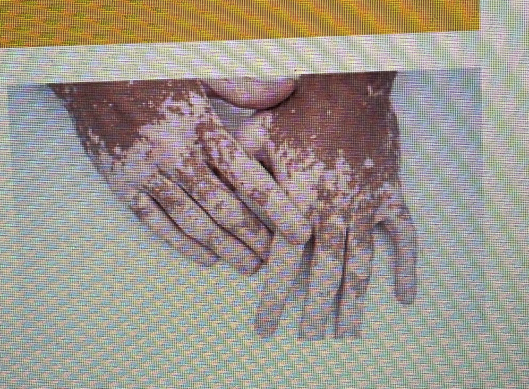 <p>vitiligo</p>