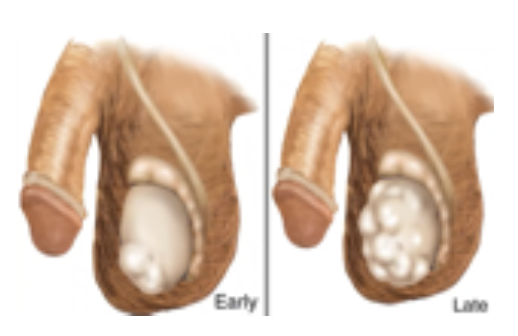 <p>Small, firm,‬ non tender nodule on testis‬</p>