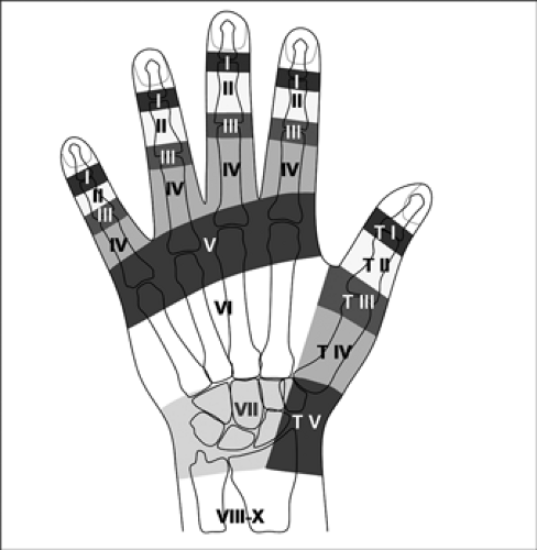 surgical repairs are much more common for extensor injuries
tx is less complex and healing response is greater as compared to flexor injuries
7 zones identified to classify injury 
easier to manage d/t less complex nature of anatomy