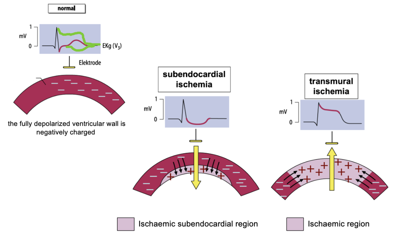 Leads that correspond to the area of the heart supplied by the affected coronary artery, typically leads V5 & V6, & the inferior leads (II, III, & aVF).
