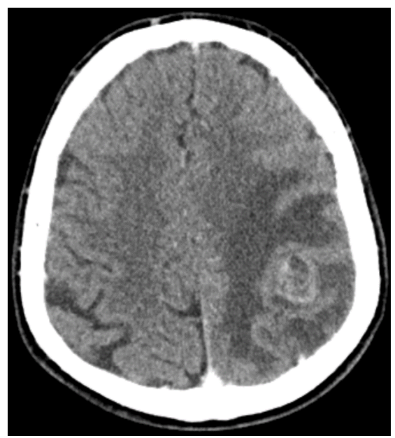 <p>What can be seen in this CT image?</p>