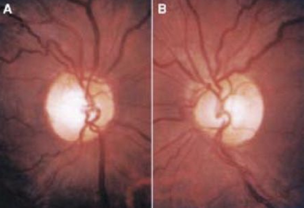 <ul><li><p>Treat Tuberculosis</p></li><li><p>Bilateral progressive optic neuropathy in 2-8 months after starting drug</p></li><li><p>Causes decreased VA, color vision, and centrocecal field defects</p></li><li><p>Effects can be reversible if caught before optic atrophy set in </p></li></ul><p></p>