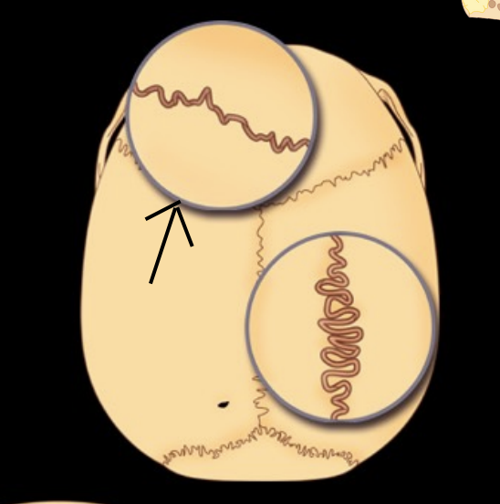 <p>What type of suture</p>