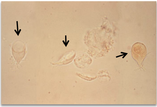<ul><li><p class="">Intestinal protozoan</p></li><li><p class="">Pear-shaped with flagella and two nuclei ("face")</p></li><li><p class="">Rare in urine; enters via fecal contamination</p></li><li><p class="">Often mistaken for debris or epithelial cells</p><p class=""></p></li></ul><p></p>