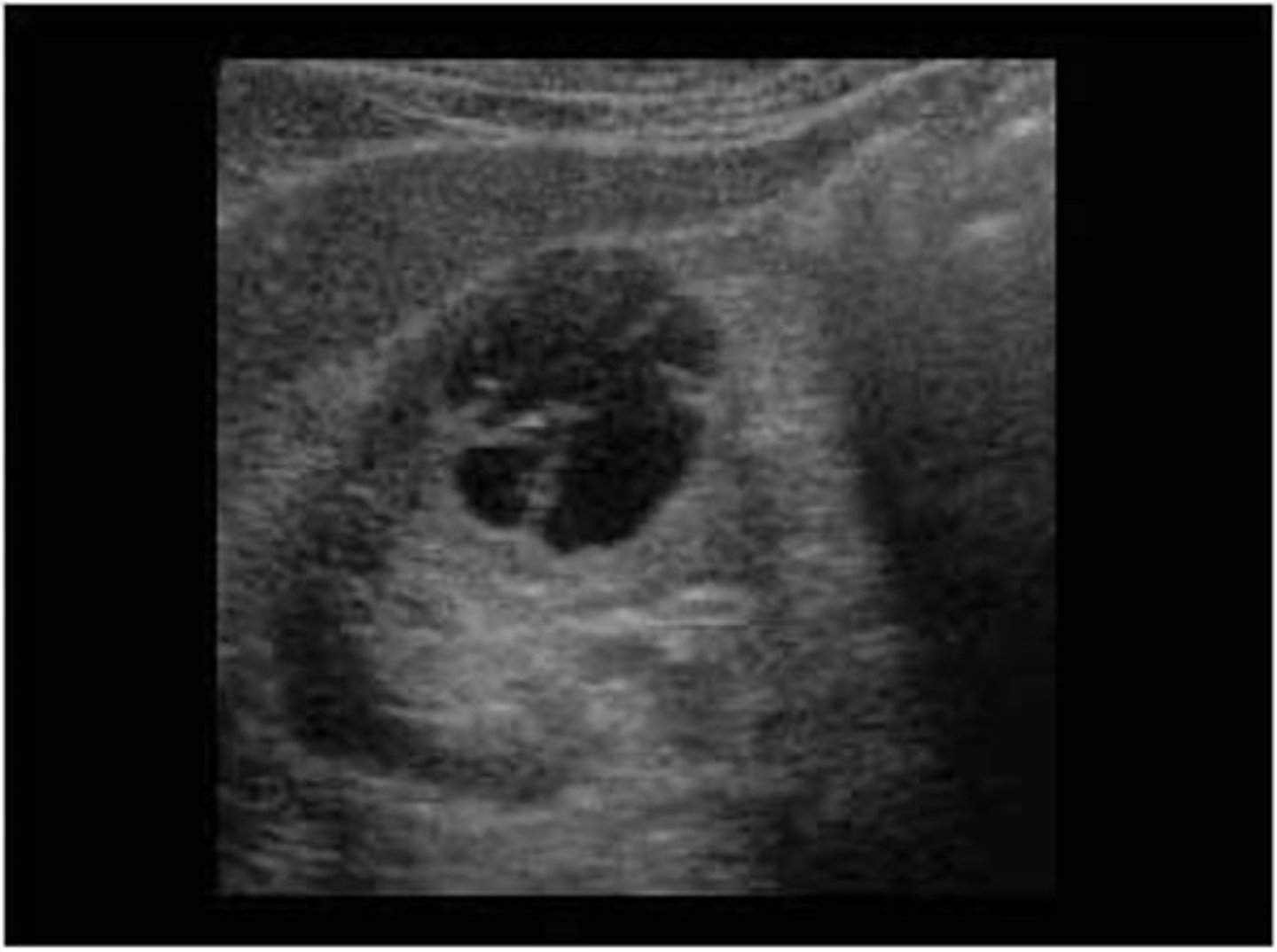 <p>A complex cyst is normally the result of ___ or ___</p>